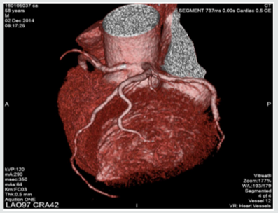 Lupinepublishers-openaccess-cardiology