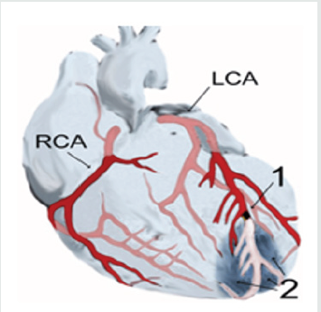 Lupinepublishers-openaccess-cardiology