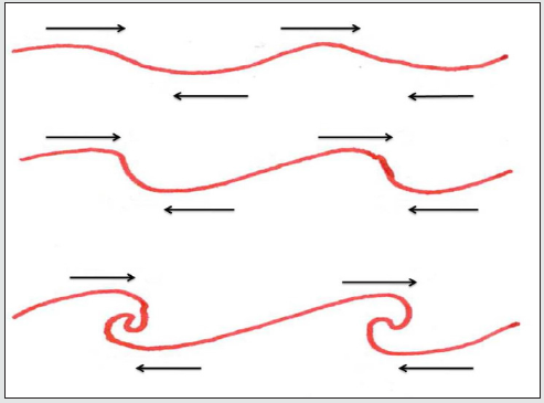 Click here to view Large Figure 4 Lupinepublishers-openaccess-cardiology