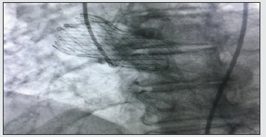 Click here to view Large Figure 1 Lupinepublishers-openaccess-cardiology