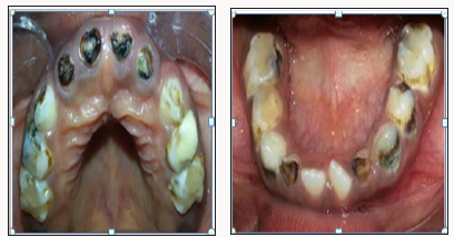 Lupinepublishers-openaccess-dentistry-oral-healthcare