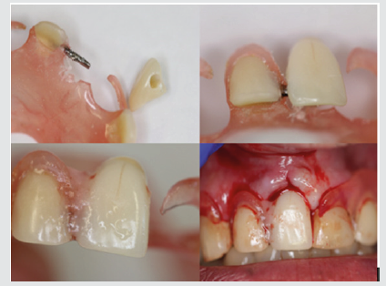 Lupinepublishers-openaccess-dentistry-oralhealth