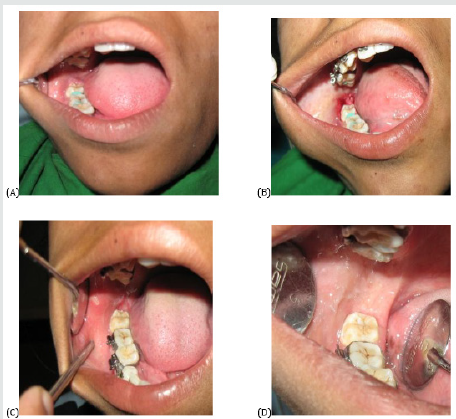 Lupinepublishers-openaccess-dentistry-oralhealth