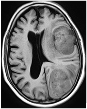 Lupinepublishers-openaccess-neurology-brain-disorders-journal
