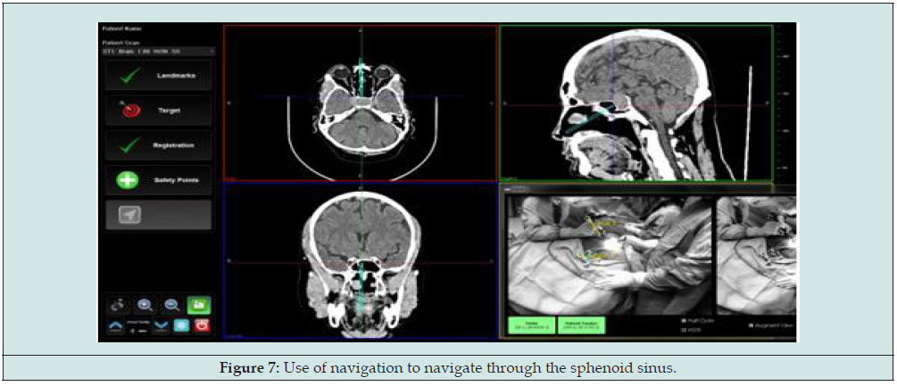 Lupinepublishers-openaccess-neurology-brain-disorders-journal