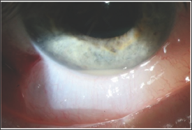 Lupinepublishers-openaccess-Ophthalmology