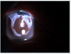 Lupinepublishers-openaccess-Ophthalmology