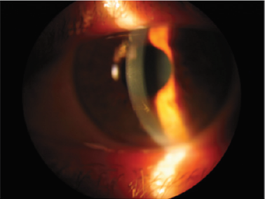 Lupinepublishers-openaccess-ophthalmology-journal