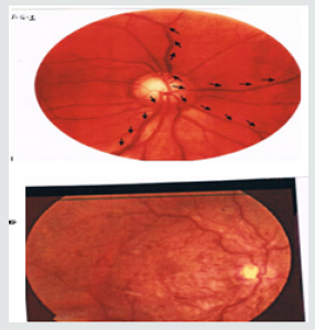 Lupinepublishers-openaccess-ophthalmology-journal