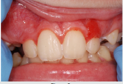 Lupinepublishers-openaccess-pediatric-dentistry-journal