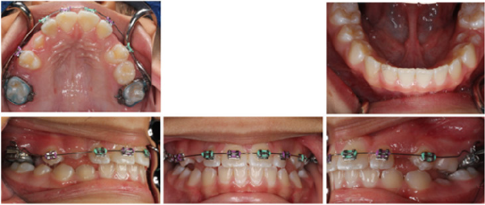 Lupinepublishers-openaccess-pediatric-dentistry-journal