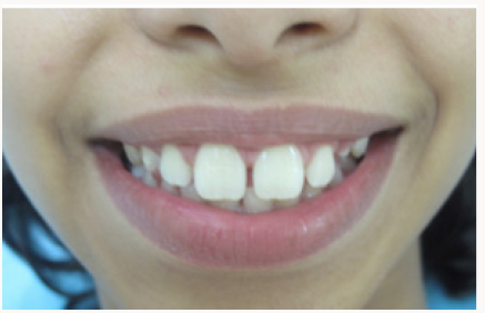 lupinepublishers-openaccess-journal-pediatric-dentistry