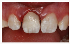 lupinepublishers-openaccess-journal-pediatric-dentistry