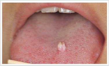 papilloma of tongue