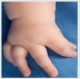 lupinepublishers-openaccess-journal-pediatrics-neonatology