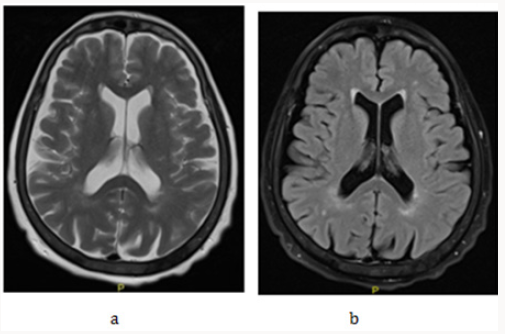 Lupinepublishers-openaccess-Surgery-Casestudies