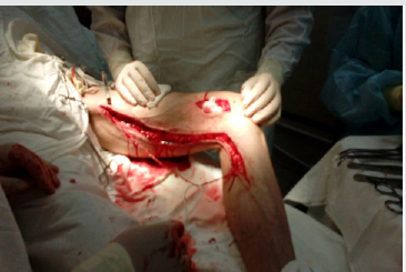 Lupinepublishers-openaccess-Surgery-Casestudies