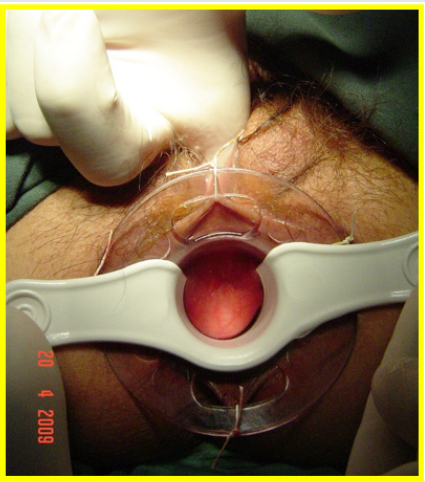Lupinepublishers-openaccess-Surgery-Casestudies
