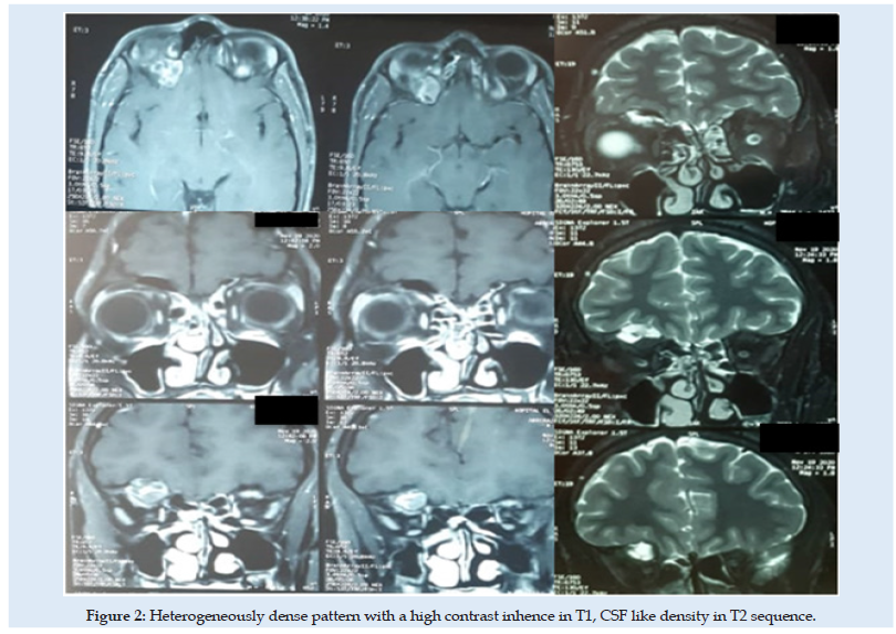 Click here to view Large Figure 2 Lupinepublishers-openaccess-Surgery-Casestudies