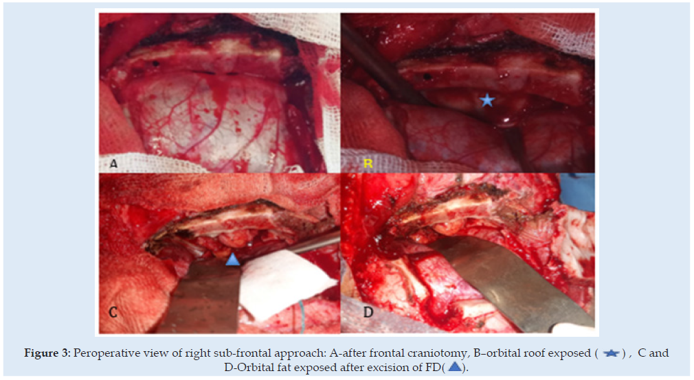 Click here to view Large Figure 3 Lupinepublishers-openaccess-Surgery-Casestudies