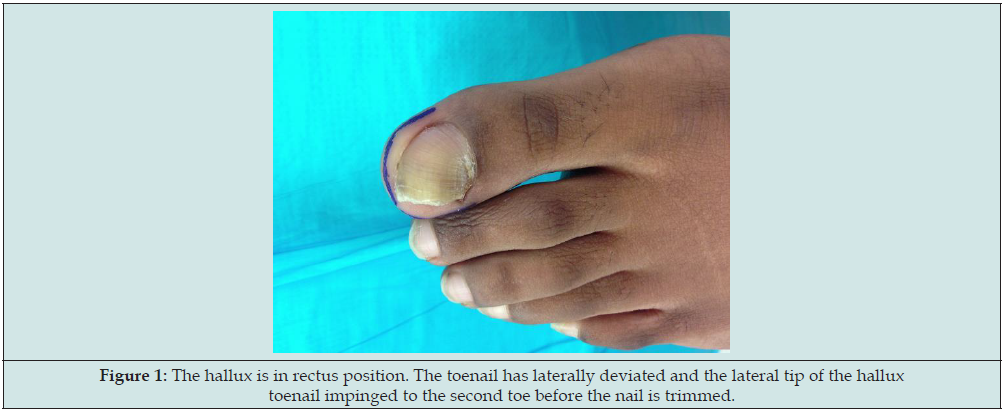 Great toenail dystrophy presenting with onychomadesis, | Open-i