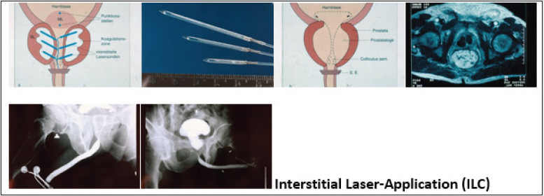 lupinepublishers-openaccess-journal-urology-nephrology
