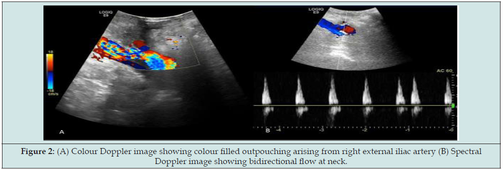 Click here to view Large Figure 2 lupinepublishers-openaccess-journal-urology-nephrology