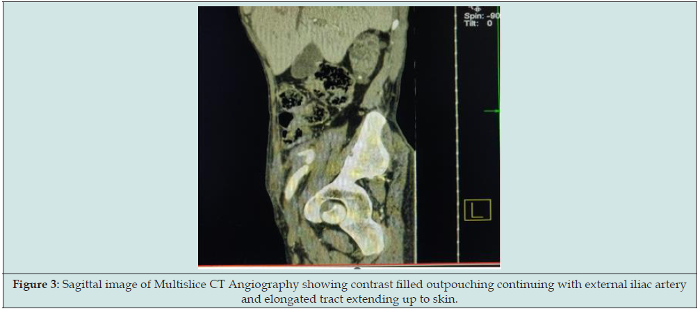 Click here to view Large Figure 3 lupinepublishers-openaccess-journal-urology-nephrology