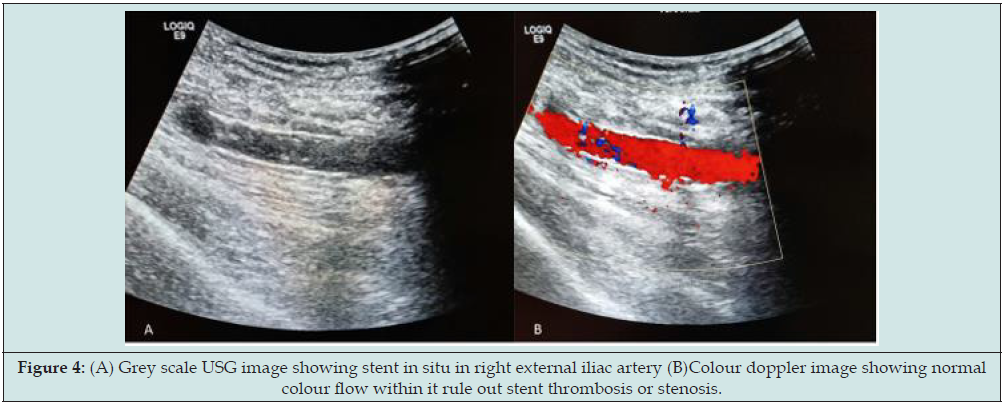 Click here to view Large Figure 4 lupinepublishers-openaccess-journal-urology-nephrology